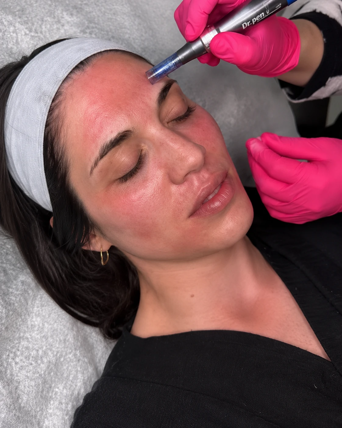Illustrative Microneedling service photography